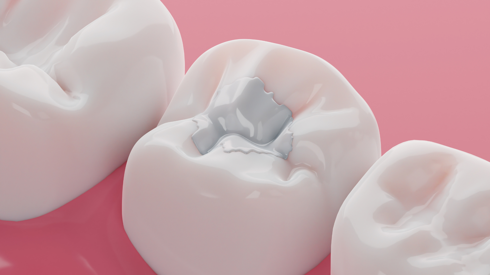 Close-up of a tooth with a silver filling, between two other teeth, all on a pink background.