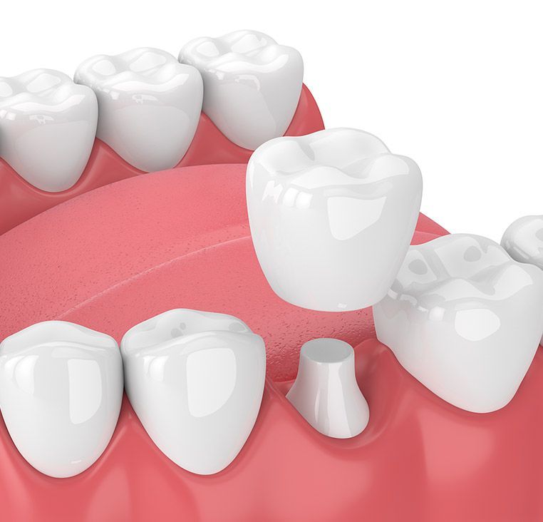 Dental crown being placed on a tooth. Pink gums, white teeth, and a crown in progress.