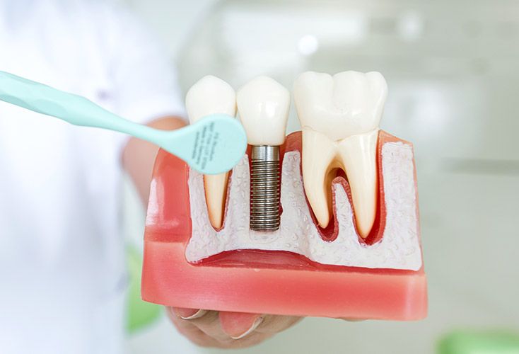 Model of a jaw with a dental implant and natural teeth, shown with a tool pointing to the implant.