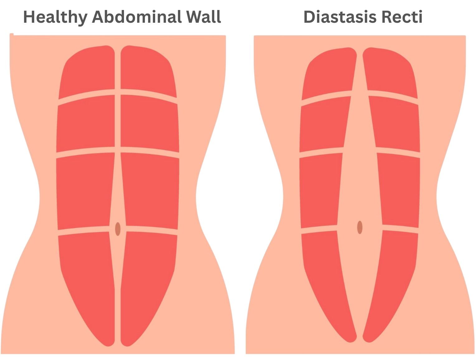 Side-by-side diagram of healthy abdominal wall and diastasis recti, shown in pink/red.