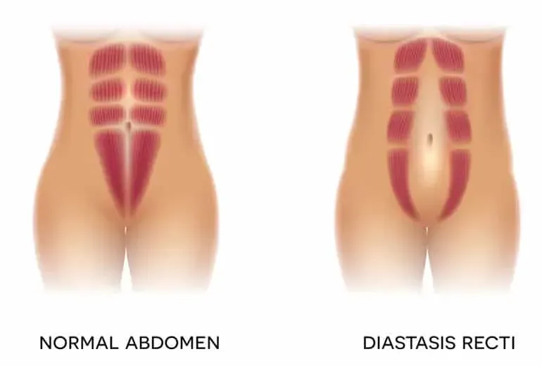Side-by-side medical diagram of a normal abdomen and diastasis recti.