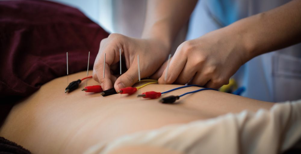 Hands placing acupuncture needles into a person’s back during treatment