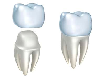 A tooth with a crown on it and a tooth without a crown.