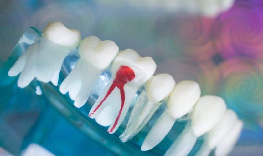 A model of a tooth with a red tooth in it.