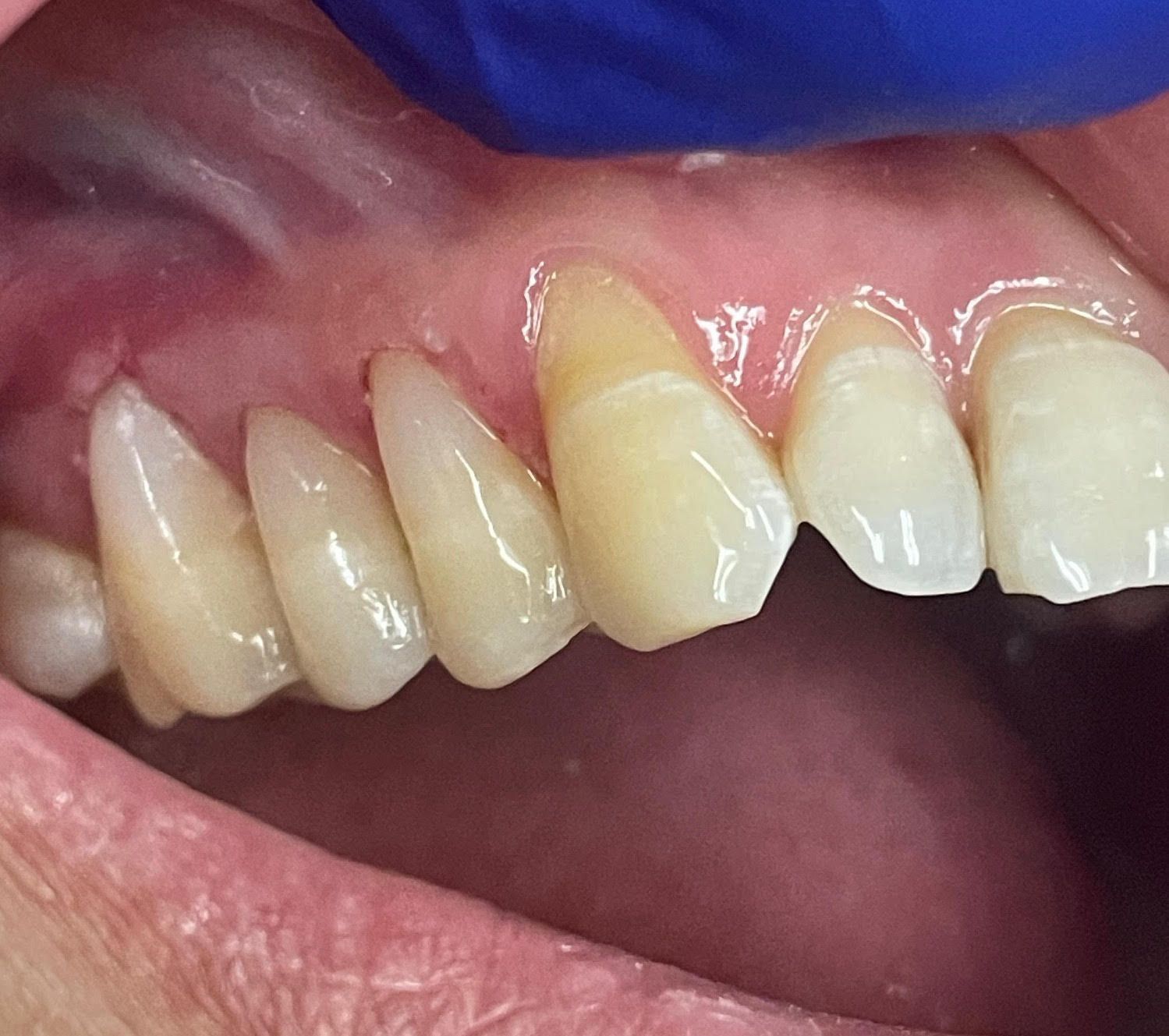 A close up of a person 's teeth with a blue glove on.
