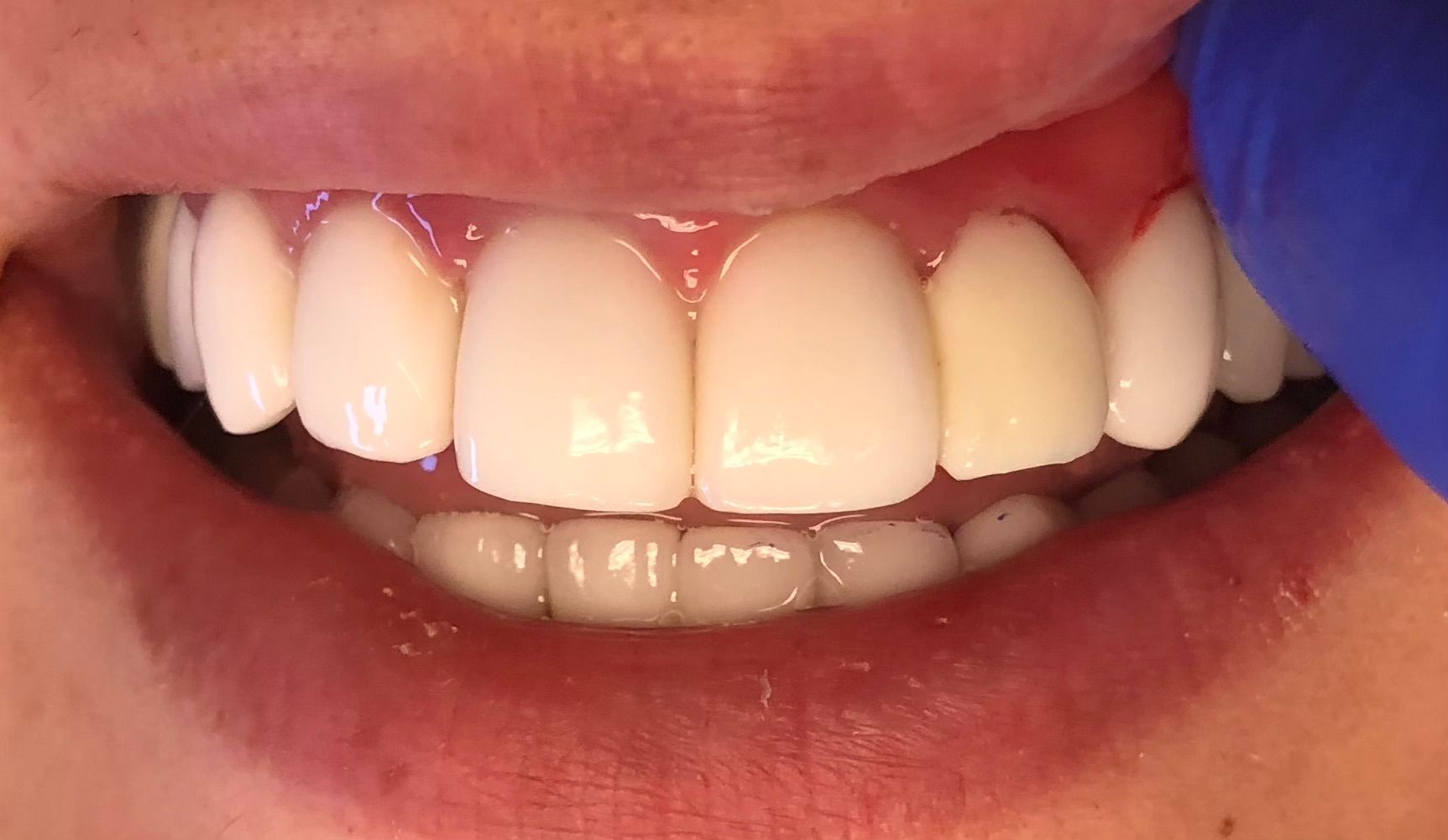 A close up of a person 's teeth with a blue glove on.