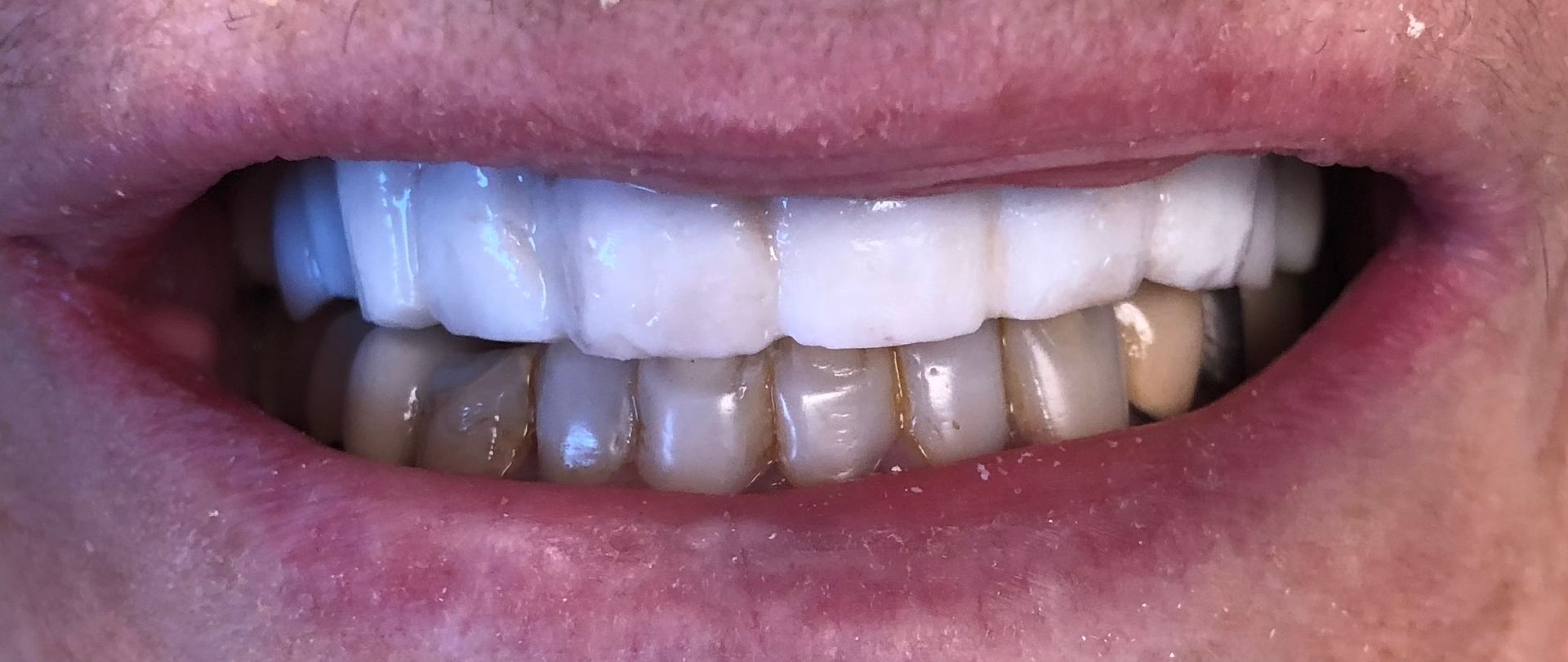 A close up of a person 's mouth with white teeth.