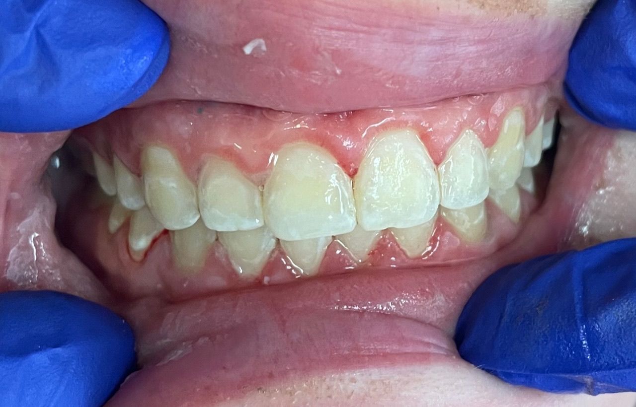 A close up of a person 's teeth with blue gloves on.