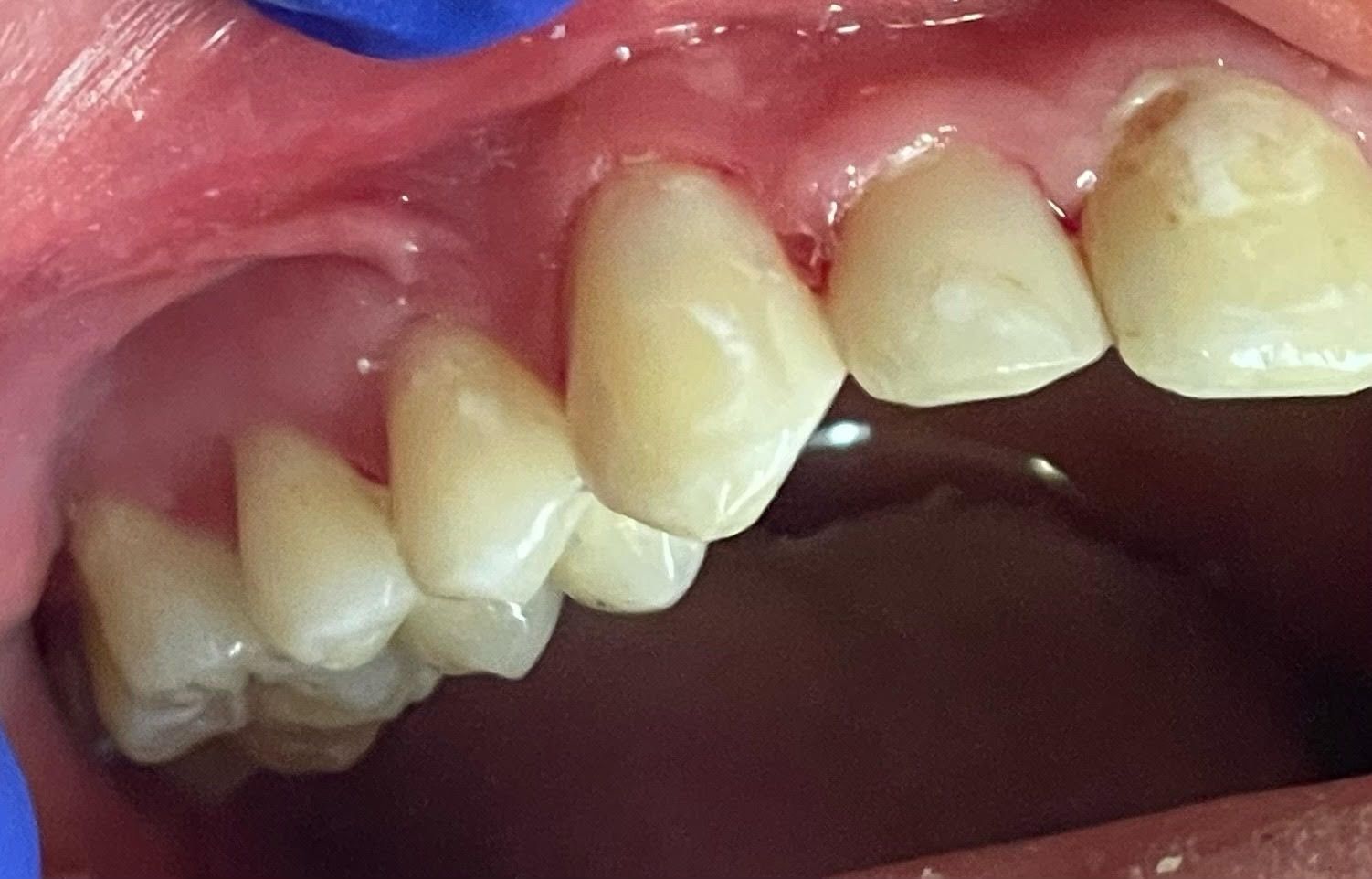 A close up of a person 's teeth with a blue glove on.