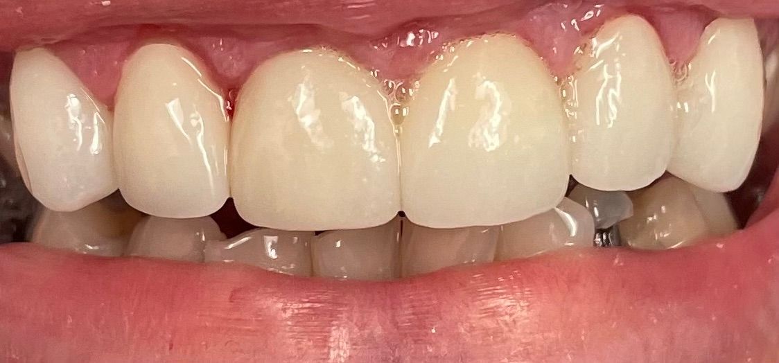 A close up of a person 's teeth with white teeth.