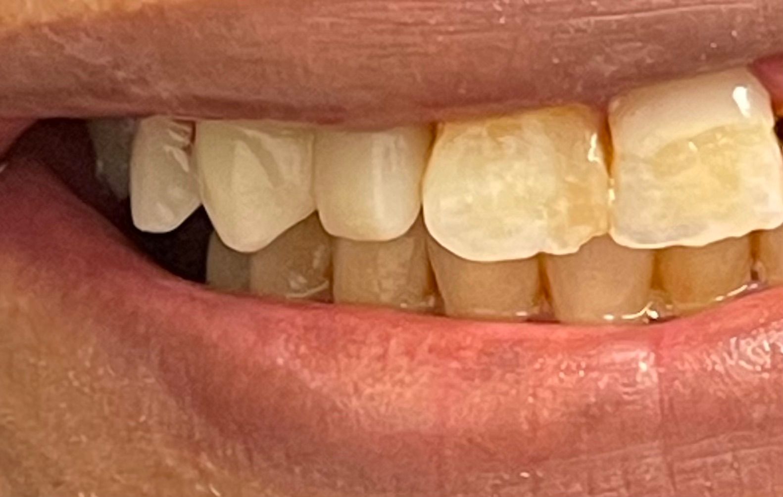 A close up of a person 's teeth with yellow spots.