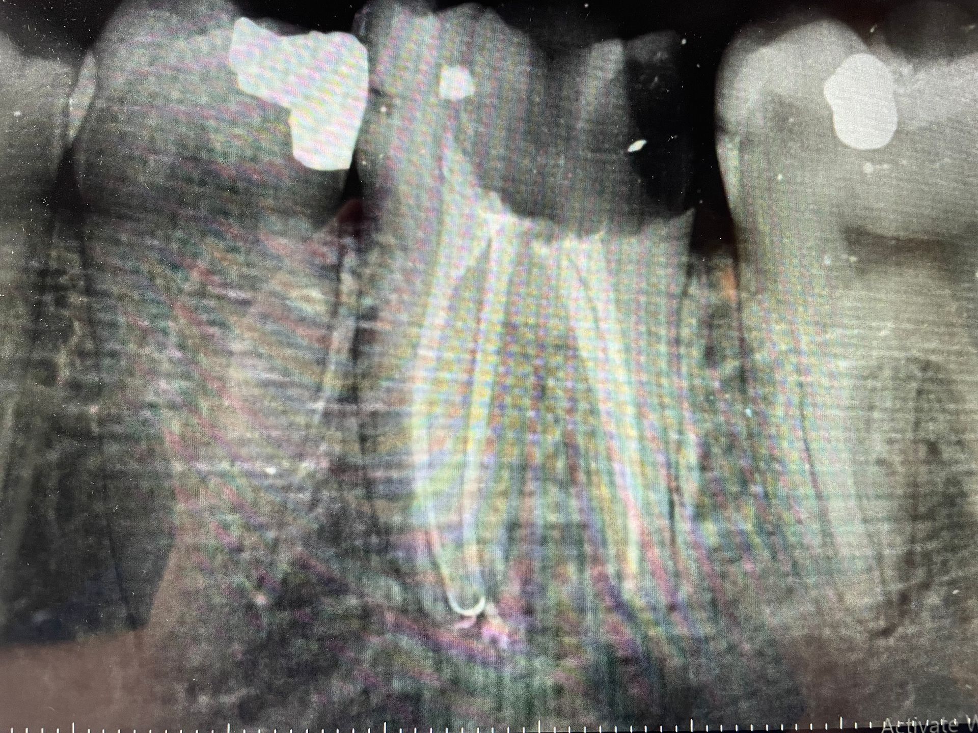 An x-ray of a person 's teeth showing a tooth with a hole in it.
