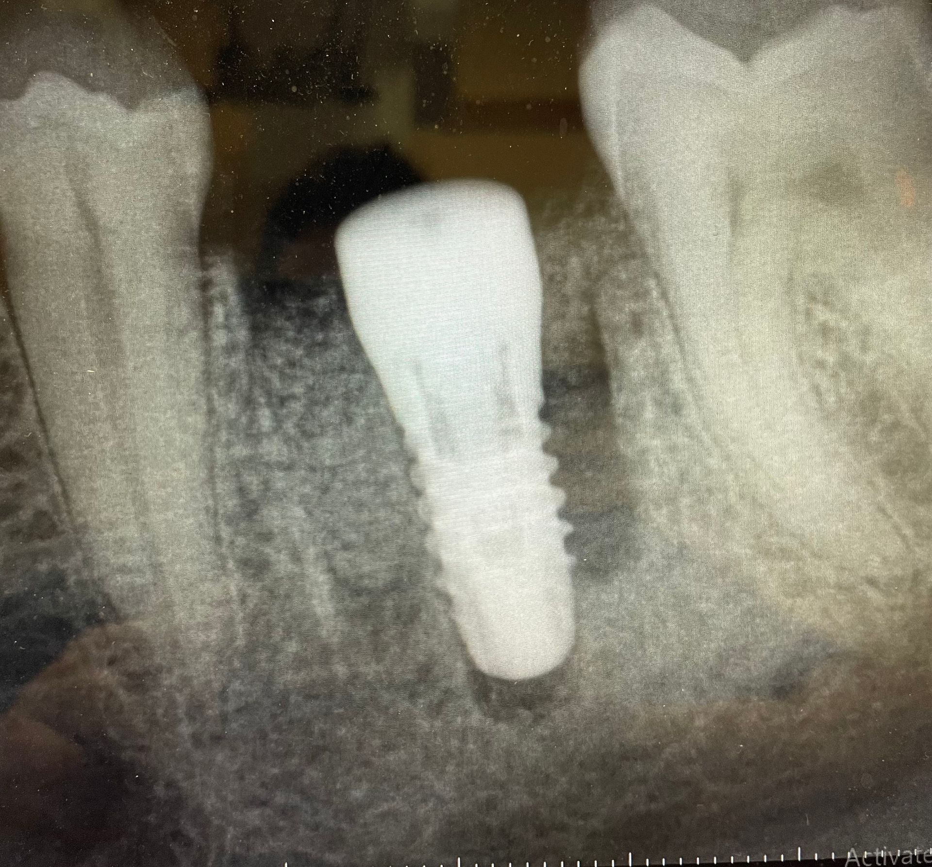 An x-ray of a tooth with a dental implant in it.