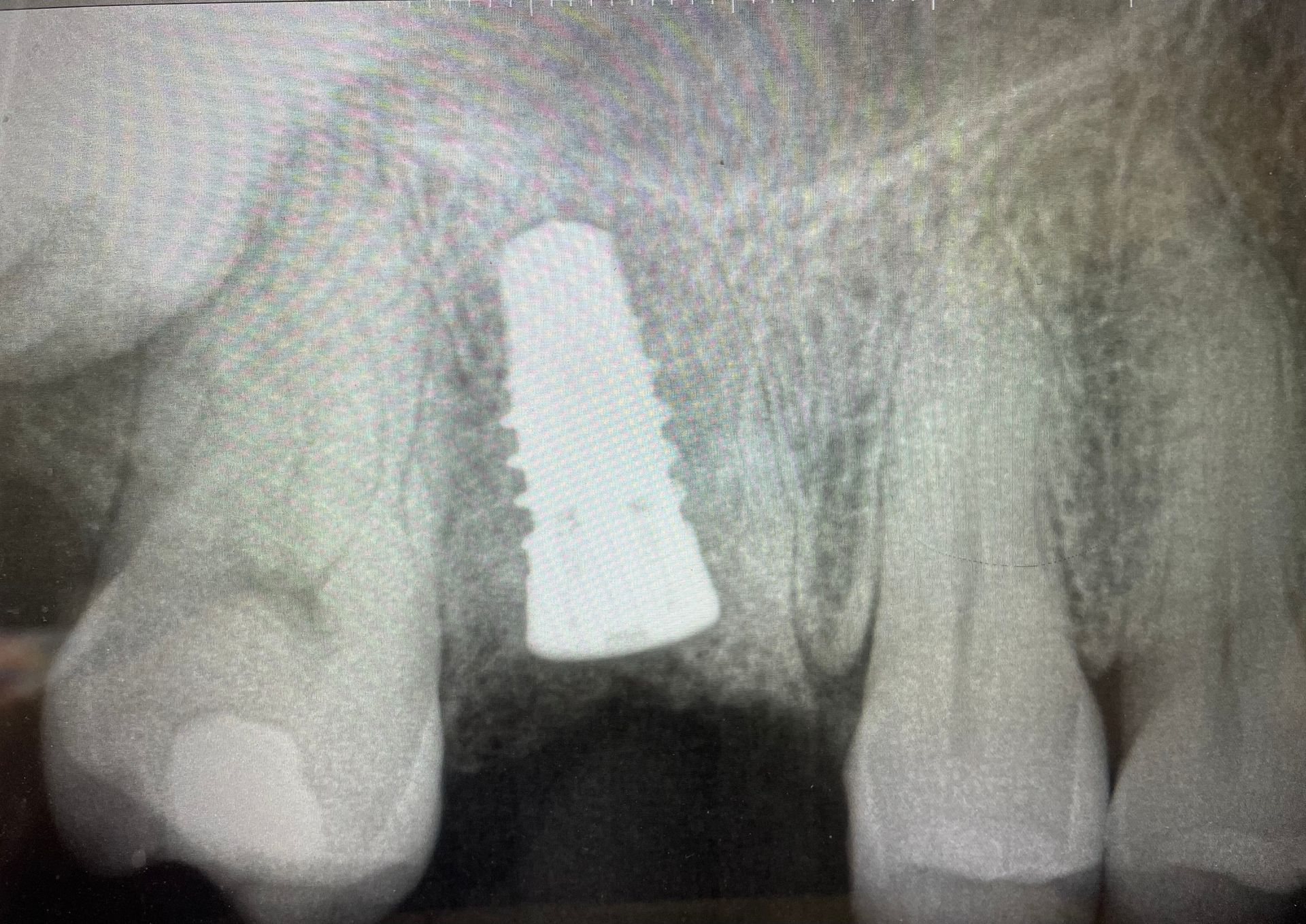 An x-ray of a tooth with a dental implant in it.