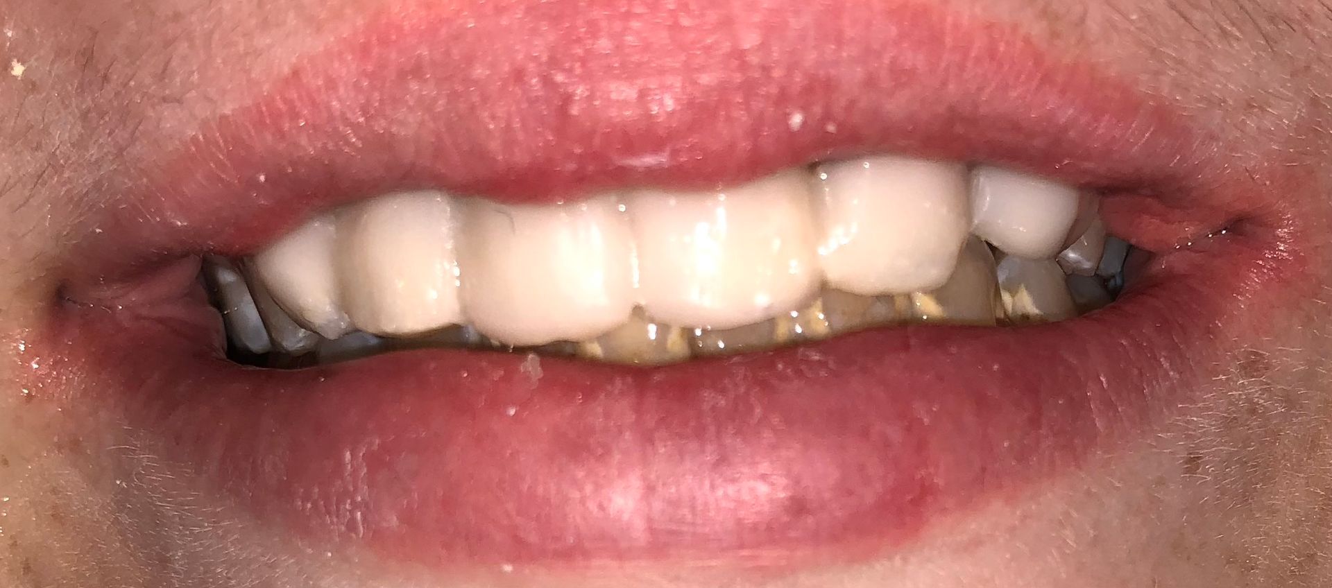 A close up of a person 's mouth with white teeth.