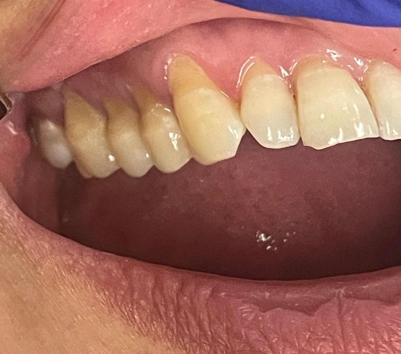 A close up of a person 's teeth with a blue glove on.