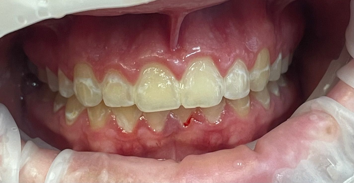 A close up of a person 's teeth with gloves on.