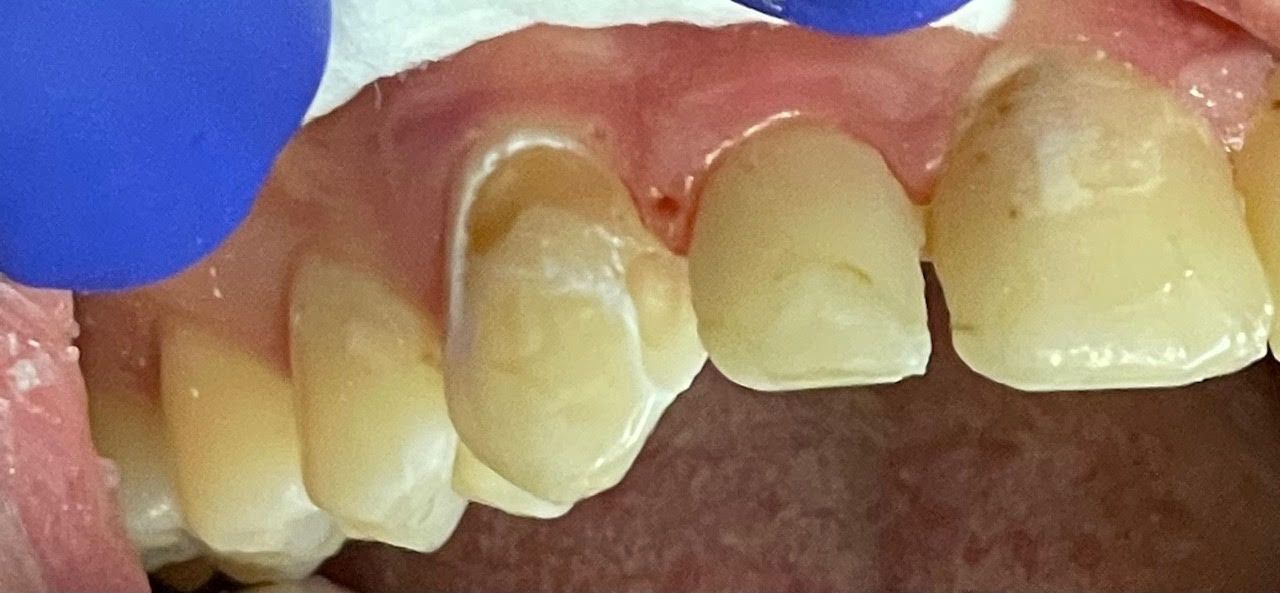 A close up of a person 's teeth with blue gloves on.