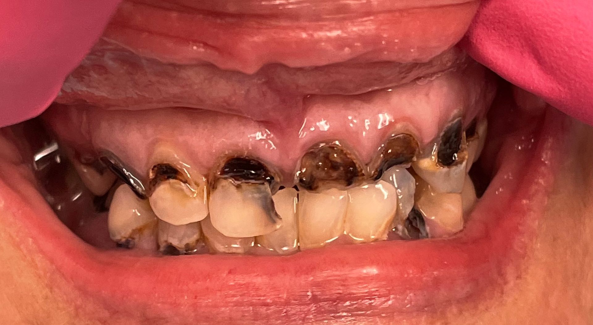 A close up of a person 's teeth with a pink glove on.