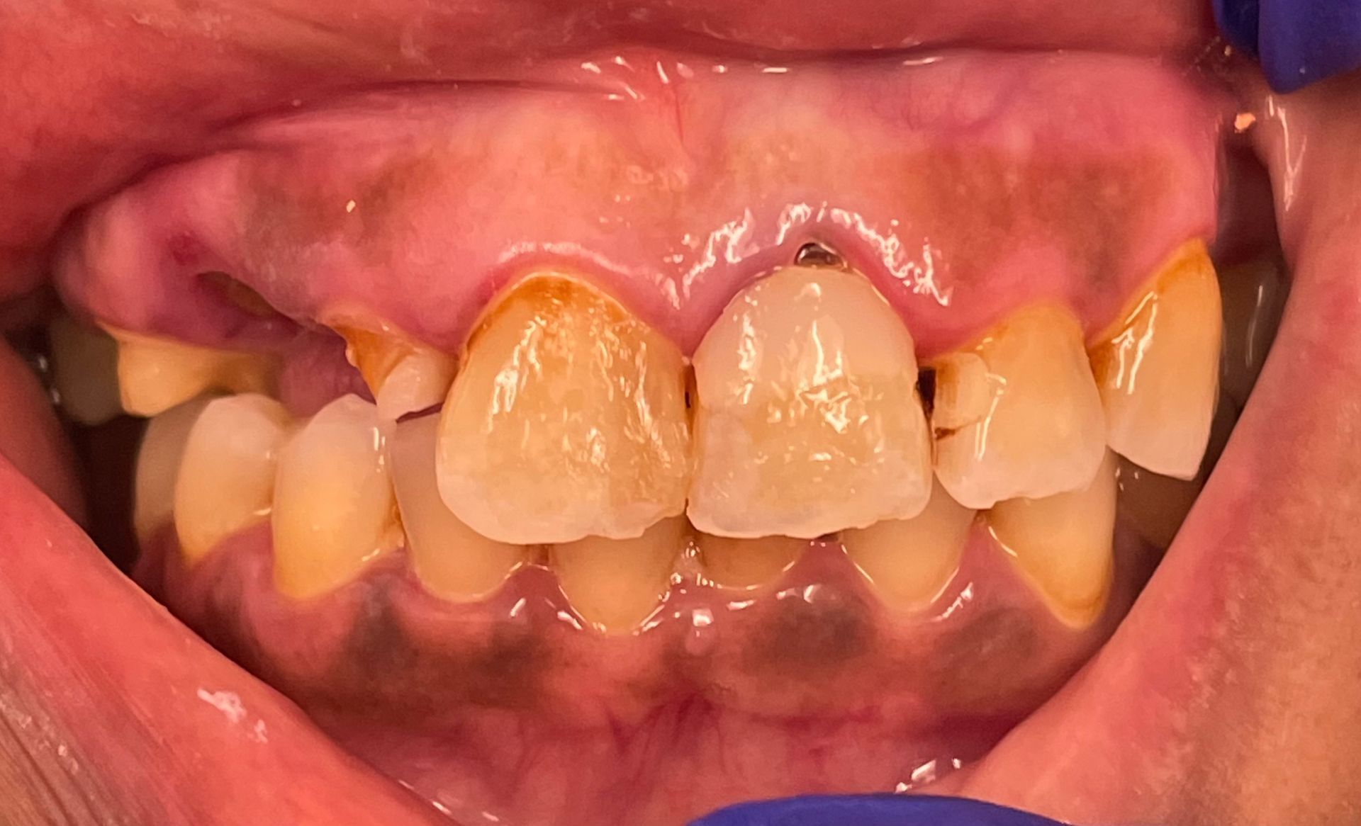 A close up of a person 's mouth with a tooth missing.