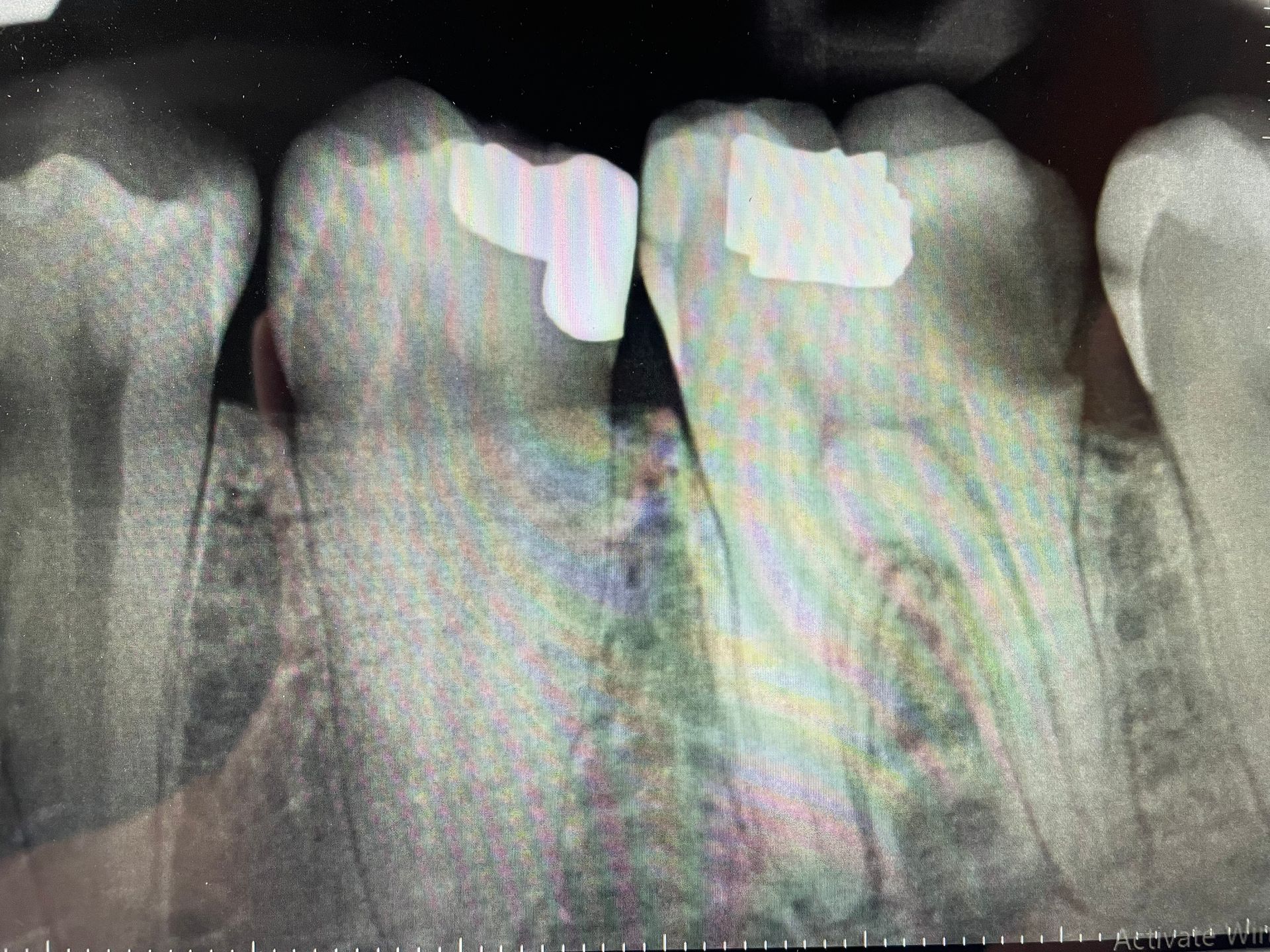 A close up of an x-ray of a person 's teeth.