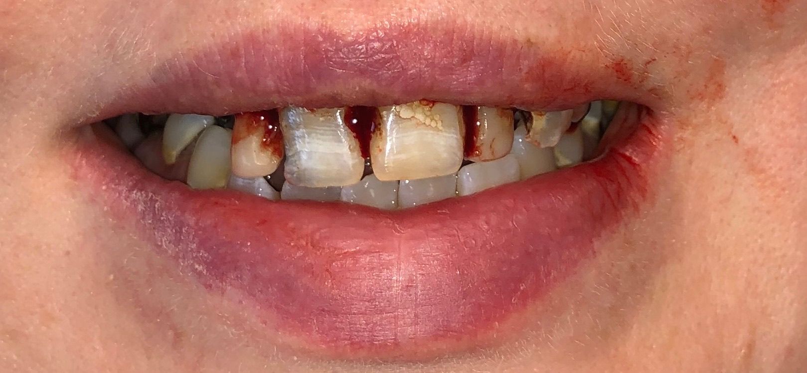 A close up of a person 's mouth with a broken tooth.