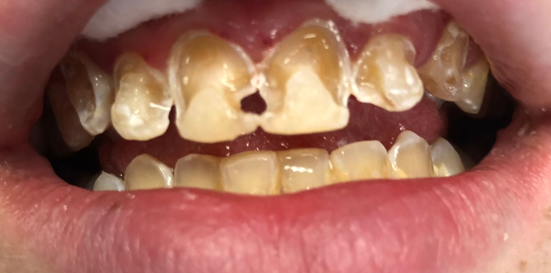 A close up of a person 's teeth with a hole in them.