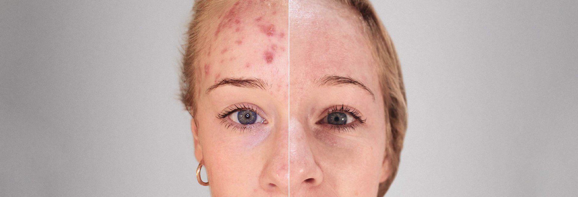 prima e dopo acne