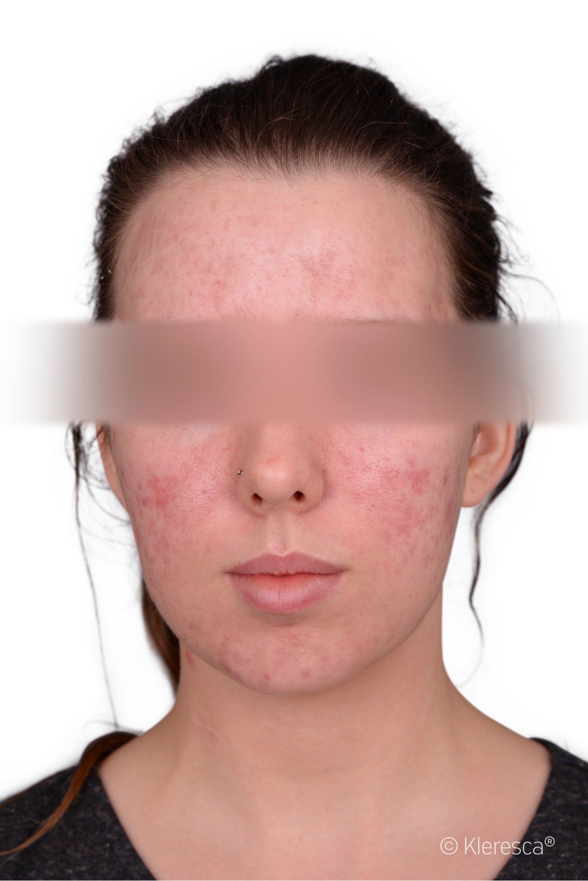 acne prima