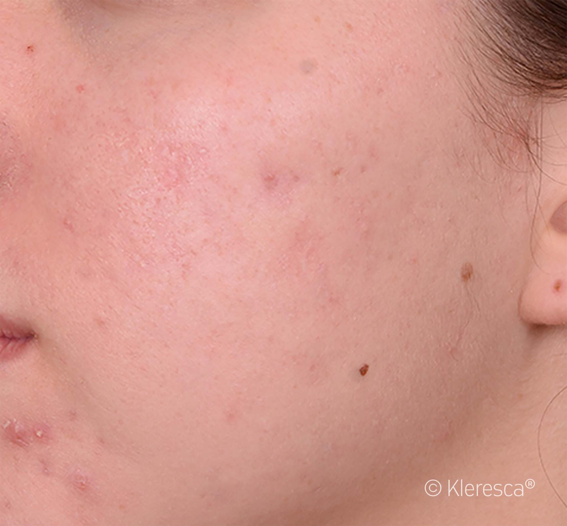 acne eliminazione