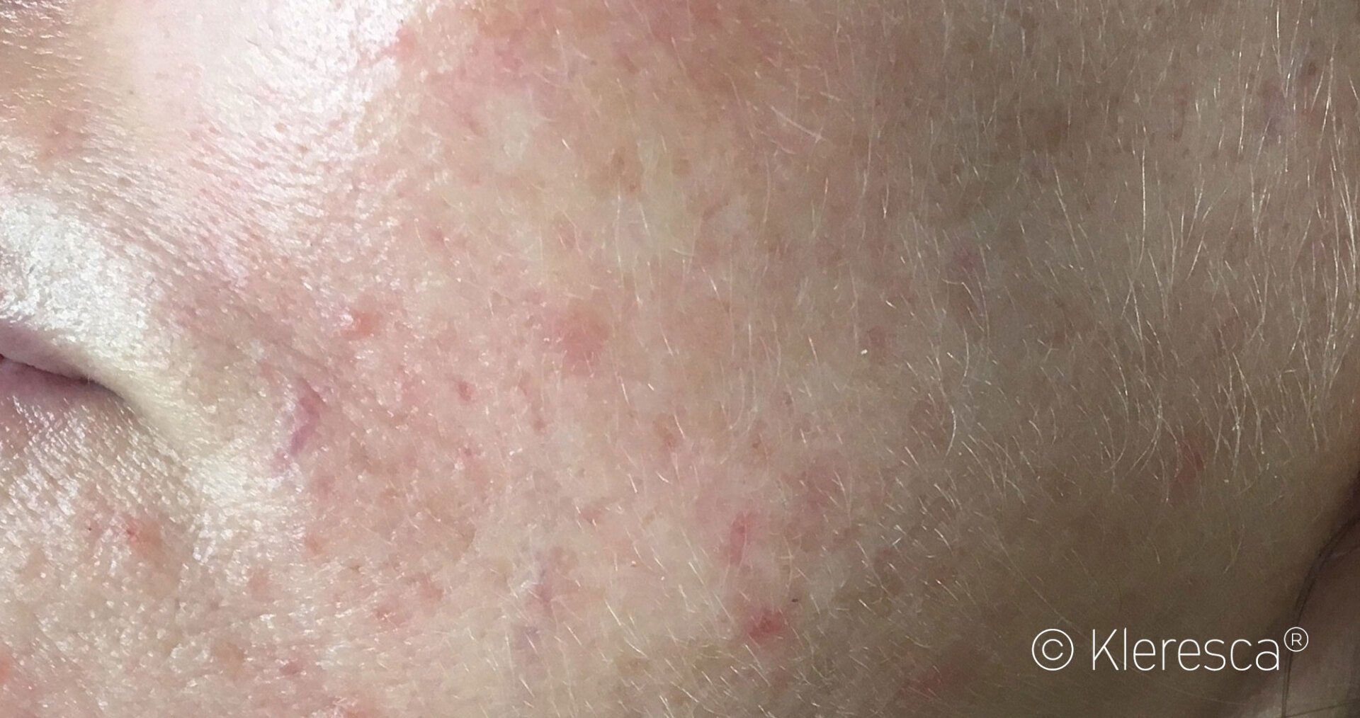 trattamento rosacea