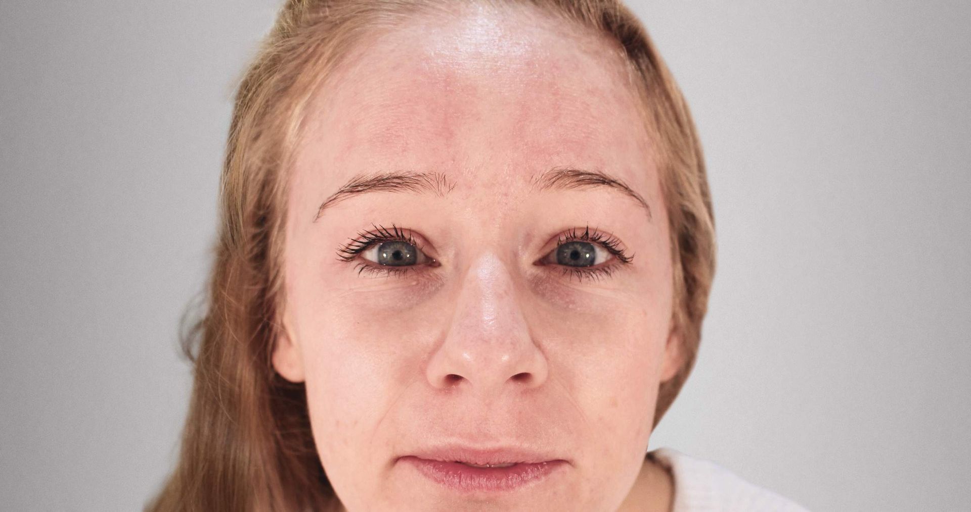 terapia acne