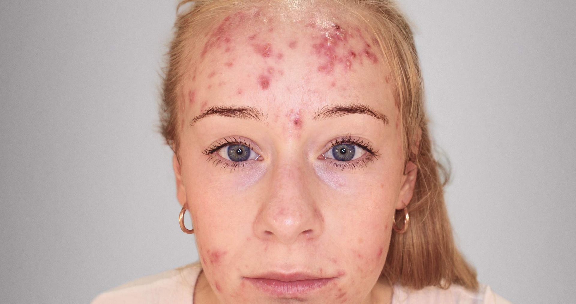 terapia acne