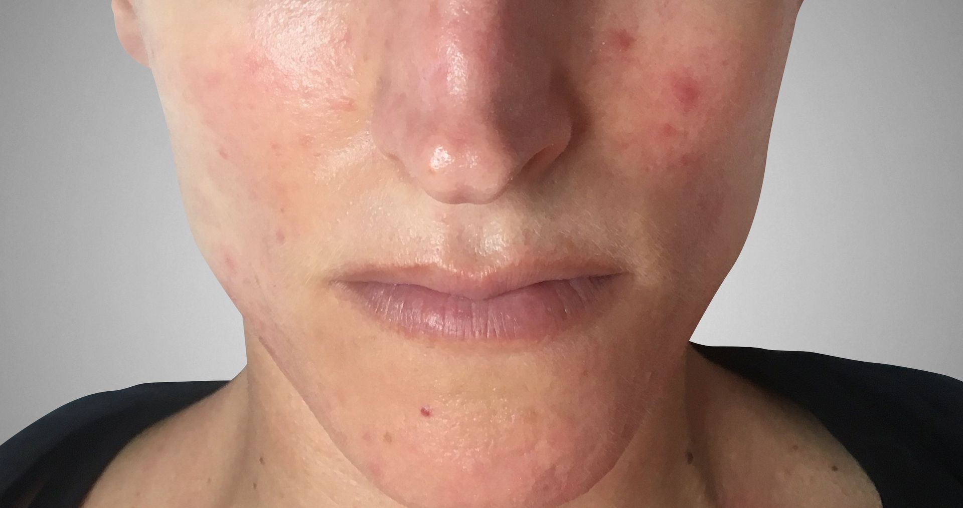 rosacea dopo il trattamento