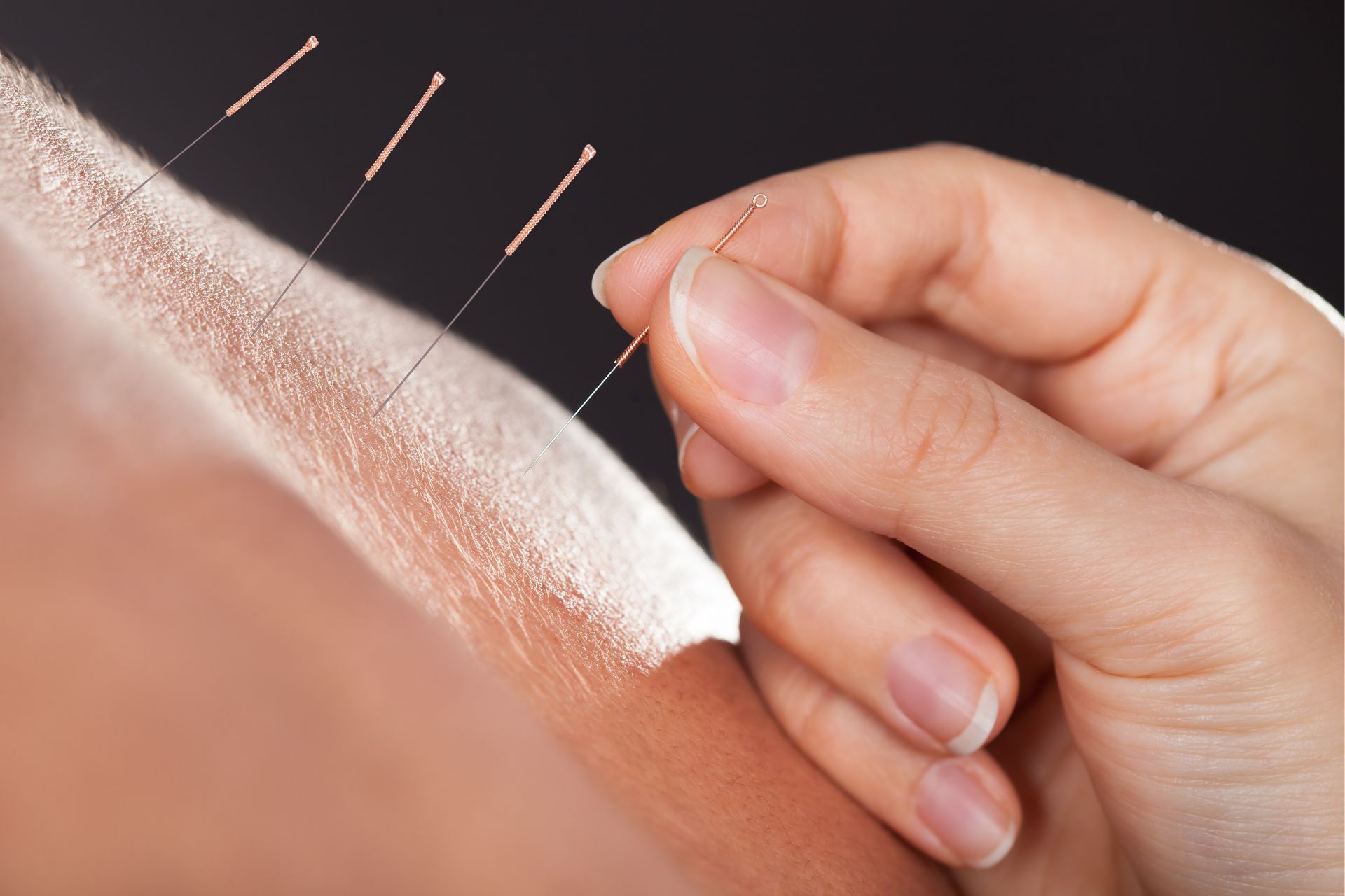 Acupuncture