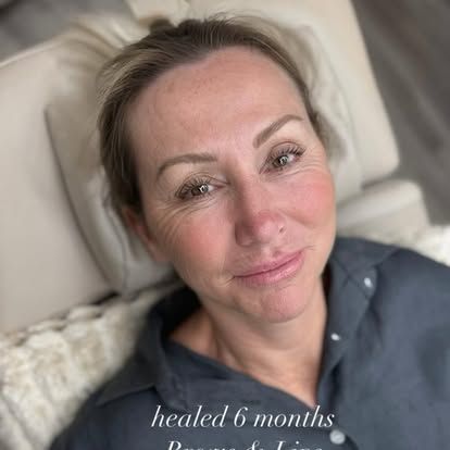 Close-up selfie of a person lying on a pillow, wearing a gray top, with text “healed 6 months” overlaid.