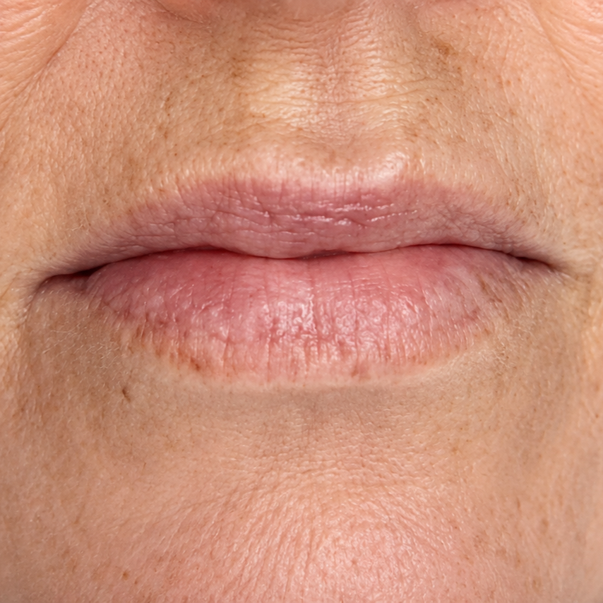 Close-up of closed lips with dry, chapped skin around the mouth