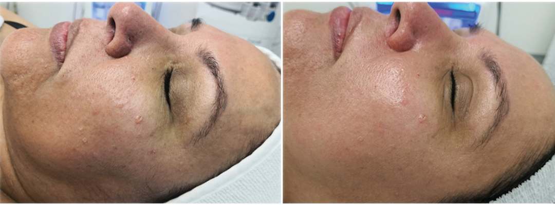 A before and after picture of a woman getting a facial treatment.