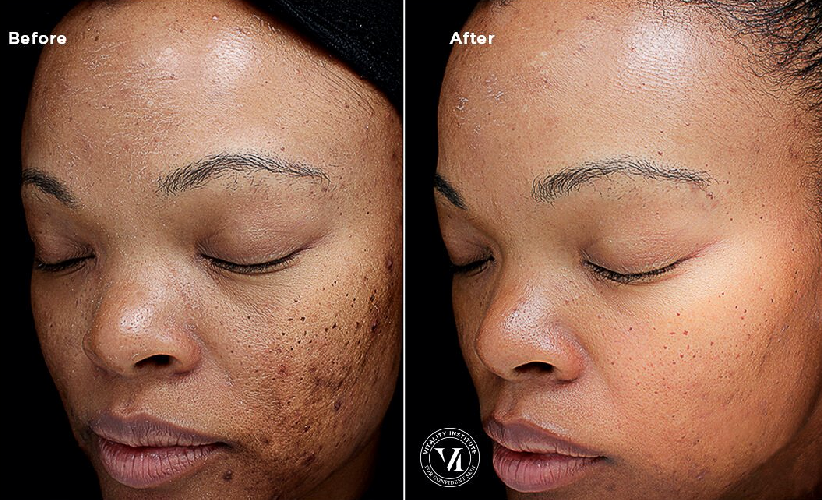 A before and after photo of a woman 's face.