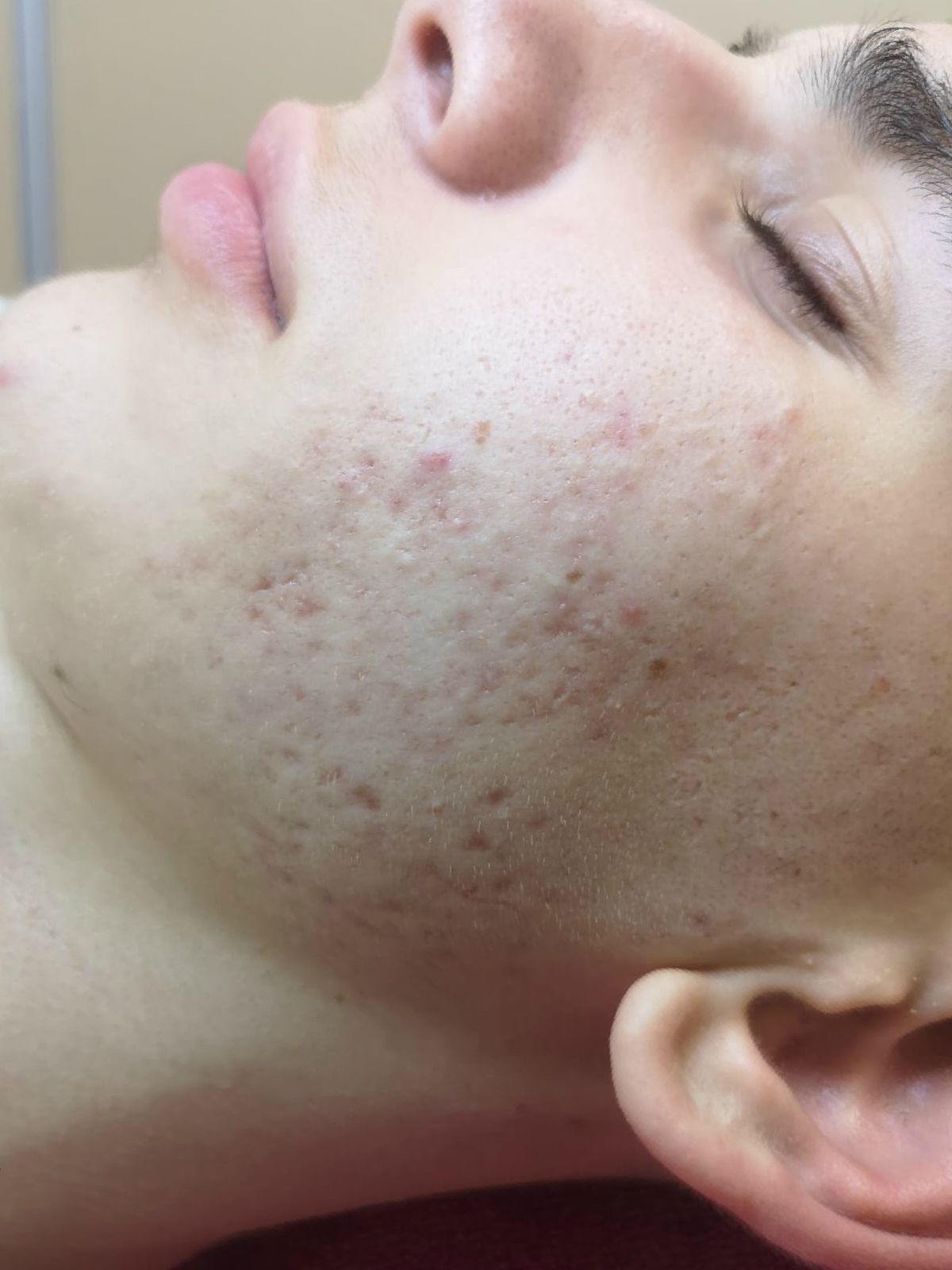 A close up of a man 's face with acne on it.
