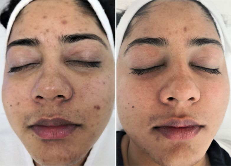 A before and after photo of a woman 's face with her eyes closed