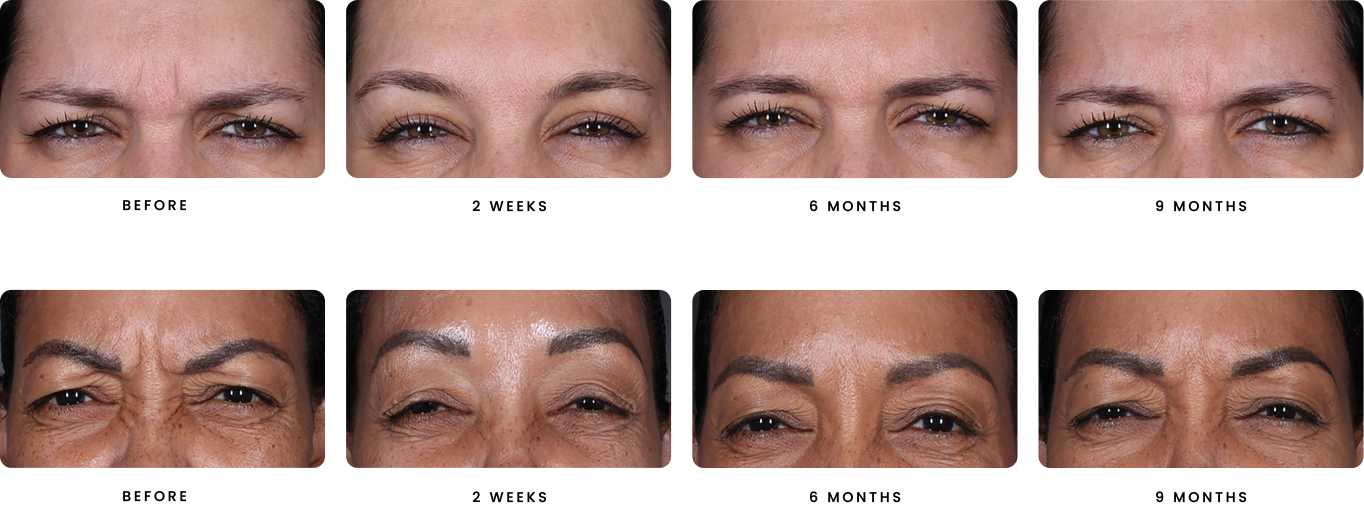 A woman 's eyebrows are shown in different stages of growth