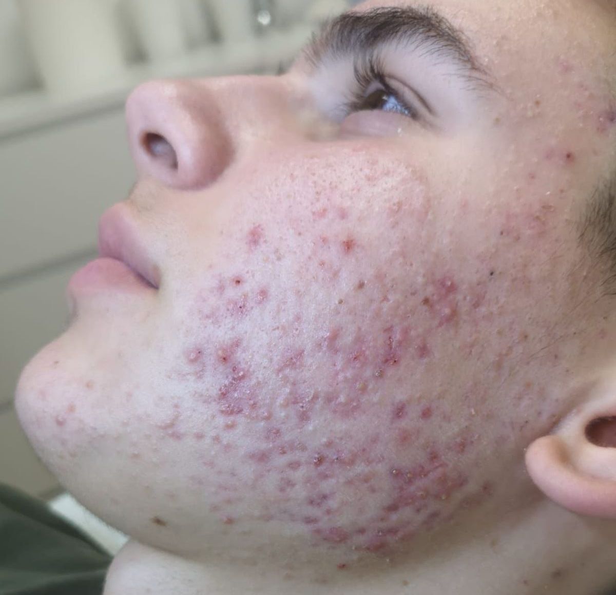 A close up of a man 's face with acne on it