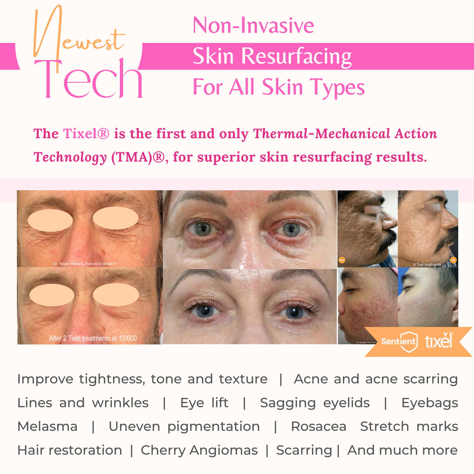 A poster for non-invasive skin resurfacing for all skin types