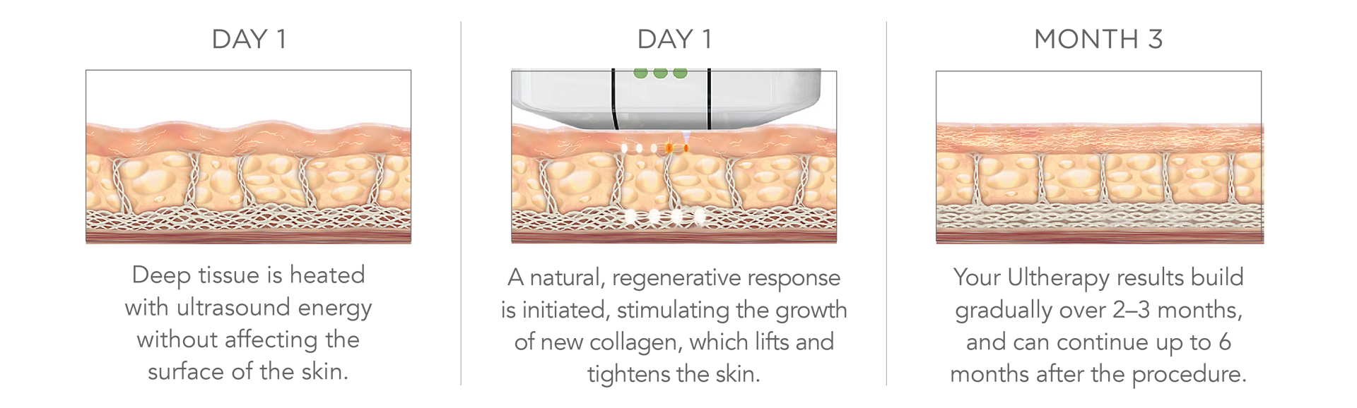 A diagram of a person 's skin showing the stages of a treatment.