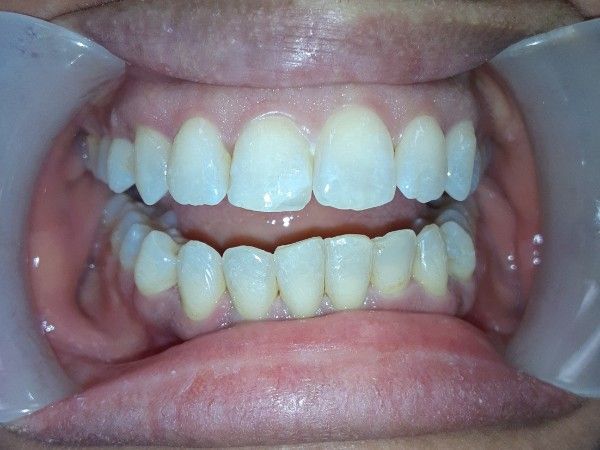 A close up of a man 's teeth with a mustache.