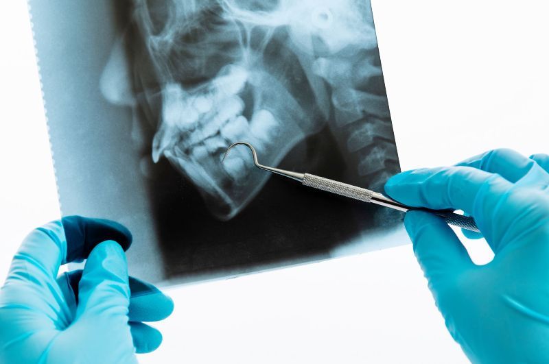 Dental X-Ray