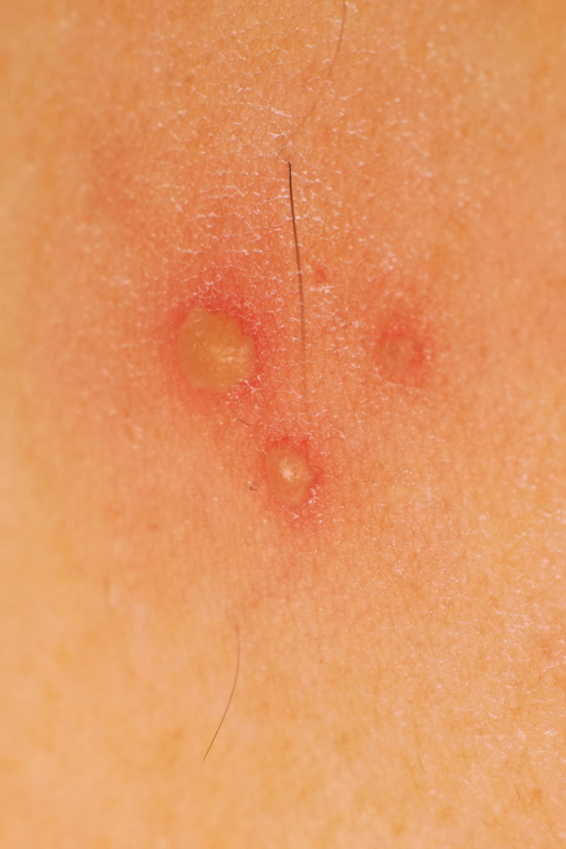 Depois do Carnaval Descobri Herpes - O Que Pode Ser e O Que Fazer Agora