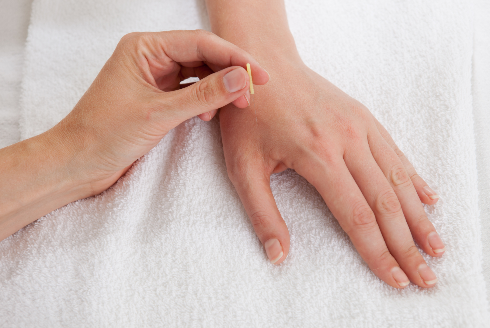A woman is getting distal point acupuncture on her hand.