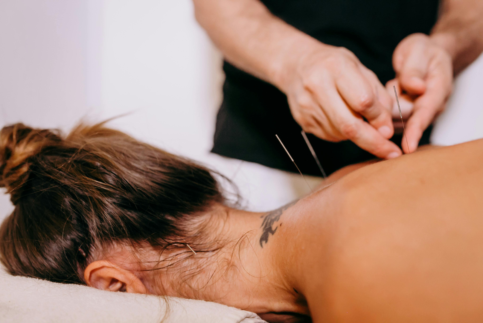 A woman is getting trigger point acupuncture treatment on her back.